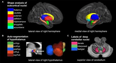 Alteration of brain nuclei in obese children with and without Prader-Willi syndrome